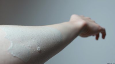 penyakit Alkaptonuria