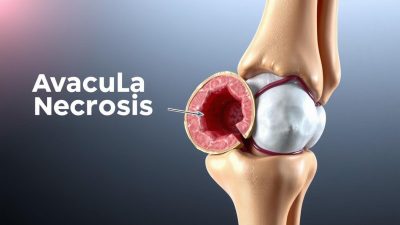 gejala Avascular Necrosis