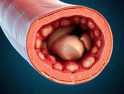 Aterosklerosis: Memahami Penyakit Jantung Berbahaya