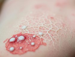 Penyakit Candidiasis: Apa yang Perlu Anda Ketahui?