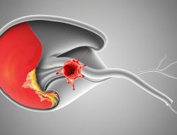 Mengenal Penyakit Chorioamnionitis: Penyebab, Gejala, dan Pengobatan