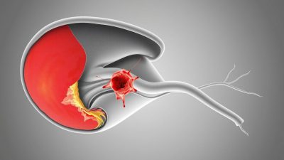 penyakit Chorioamnionitis