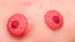 Memahami Penyakit Dermatitis Numularis