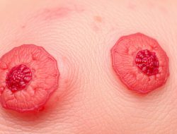 Memahami Penyakit Dermatitis Numularis
