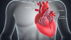 penyakit Efusi Perikardium