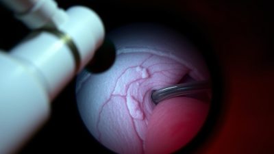 Endoskopi untuk diagnosis Esofagitis