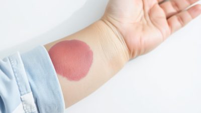 gejala Hematoma pada anak