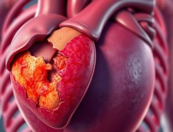 Endokarditis: Infeksi Jantung yang Perlu Diwaspadai
