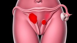 Memahami Penyakit Endometriosis: Gejala, Penyebab, dan Pengobatan