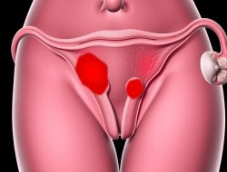 Memahami Penyakit Endometriosis: Gejala, Penyebab, dan Pengobatan