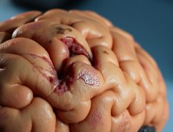 Ensefalopati: Penyakit Otak yang Perlu Diketahui
