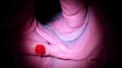 Penyakit Esofagitis: Apa yang Perlu Anda Ketahui?