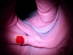 Penyakit Esofagitis: Apa yang Perlu Anda Ketahui?