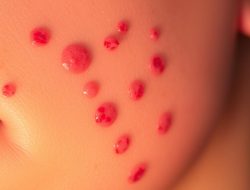 Penyakit Folikulitis: Gejala, Penyebab, dan Pengobatan