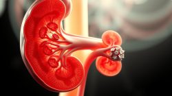 Penyakit Glomerulonefritis: Gejala, Penyebab, dan Cara Penanganannya
