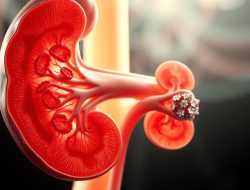 Penyakit Glomerulonefritis: Gejala, Penyebab, dan Cara Penanganannya