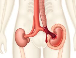 Memahami Penyakit Hematuria: Gejala, Penyebab, dan Pengobatan