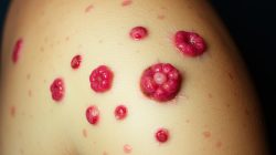 Penyakit Frambusia: Apa yang Perlu Diketahui?