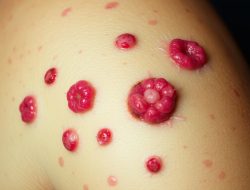 Penyakit Frambusia: Apa yang Perlu Diketahui?