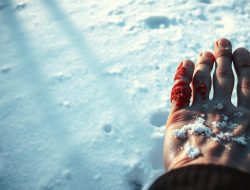 Penyakit Frostbite: Mengenal Bahaya dan Cara Mengatasinya