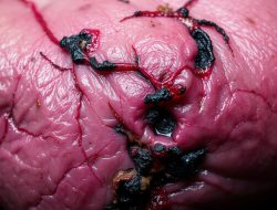Penyakit Gangrene: Apa yang Perlu Anda Ketahui?